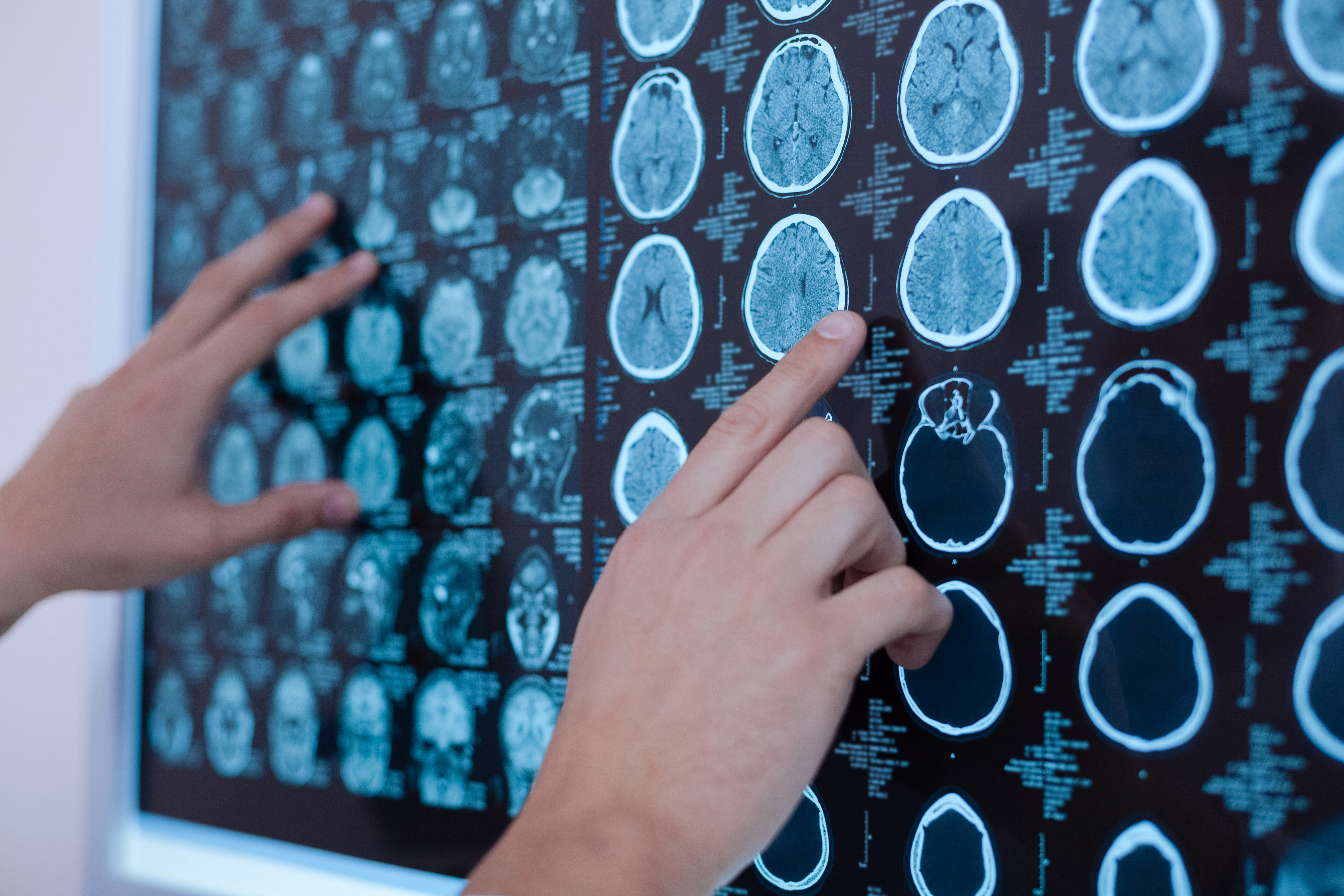 Novas diretrizes internacionais para a meningite tuberculosa