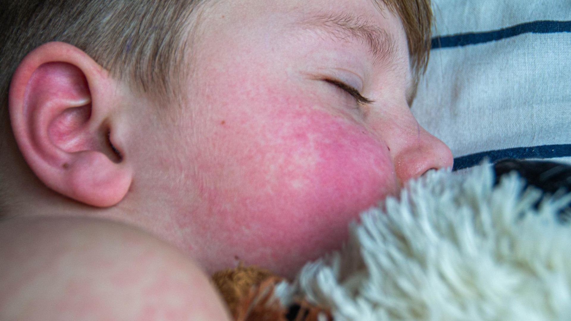 Alergia à proteína do leite: o que você precisa saber?