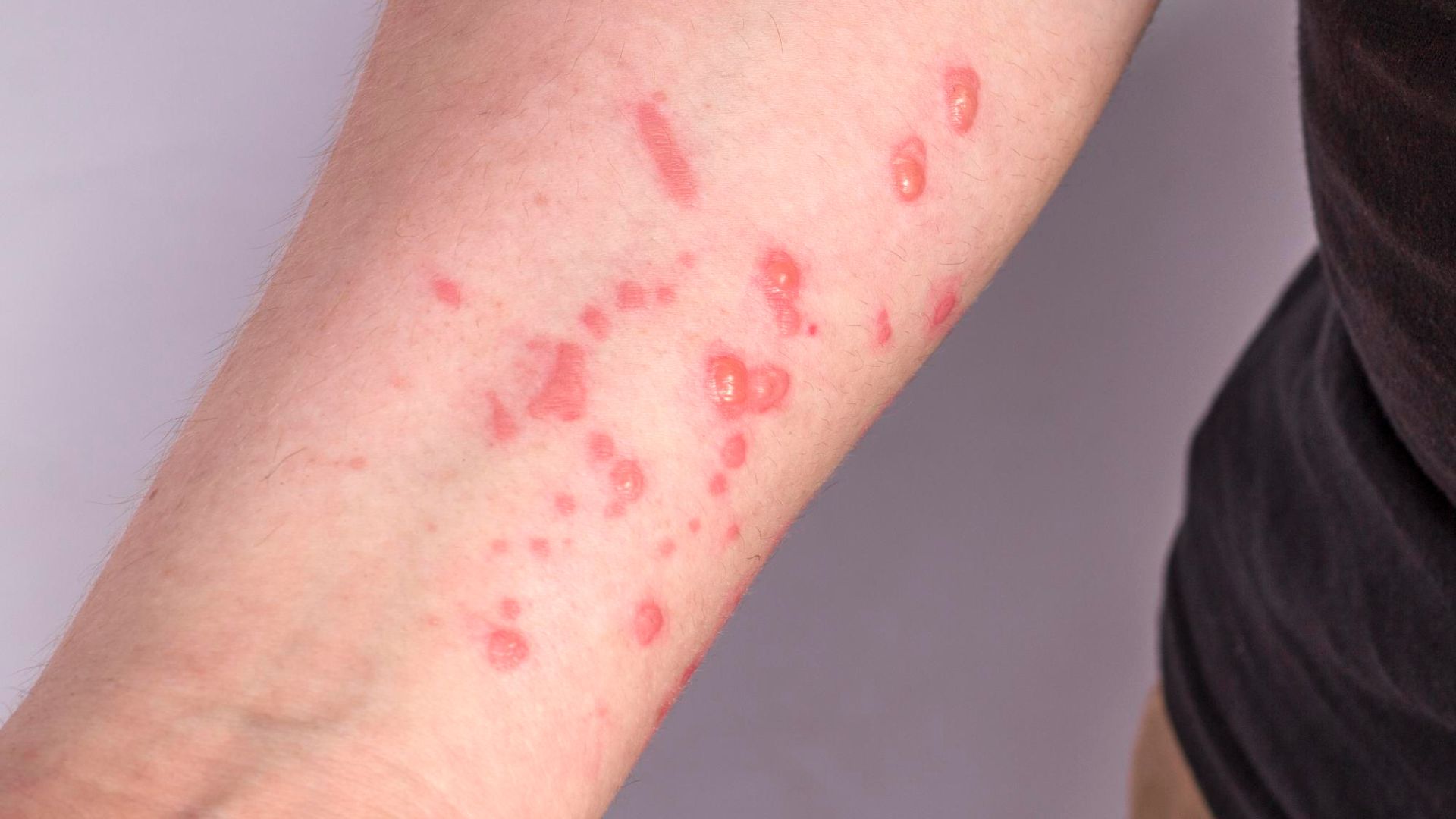Detecção da nova cepa do mpox vírus: diagnóstico e manejo clínico