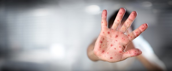 Vacina de sarampo: entenda por que ela é essencial