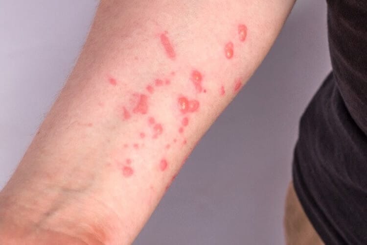 Monkeypox