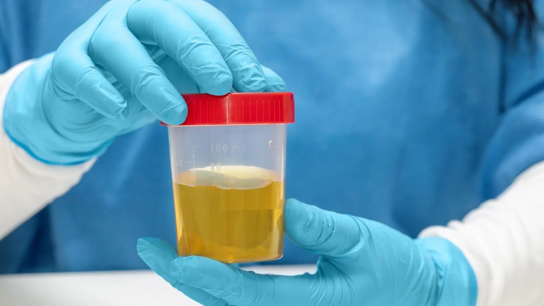 Exame de urina: entenda o passo a passo e como se preparar