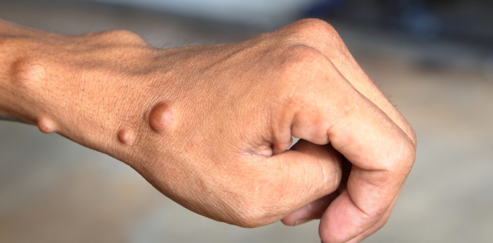 neurofibromatose