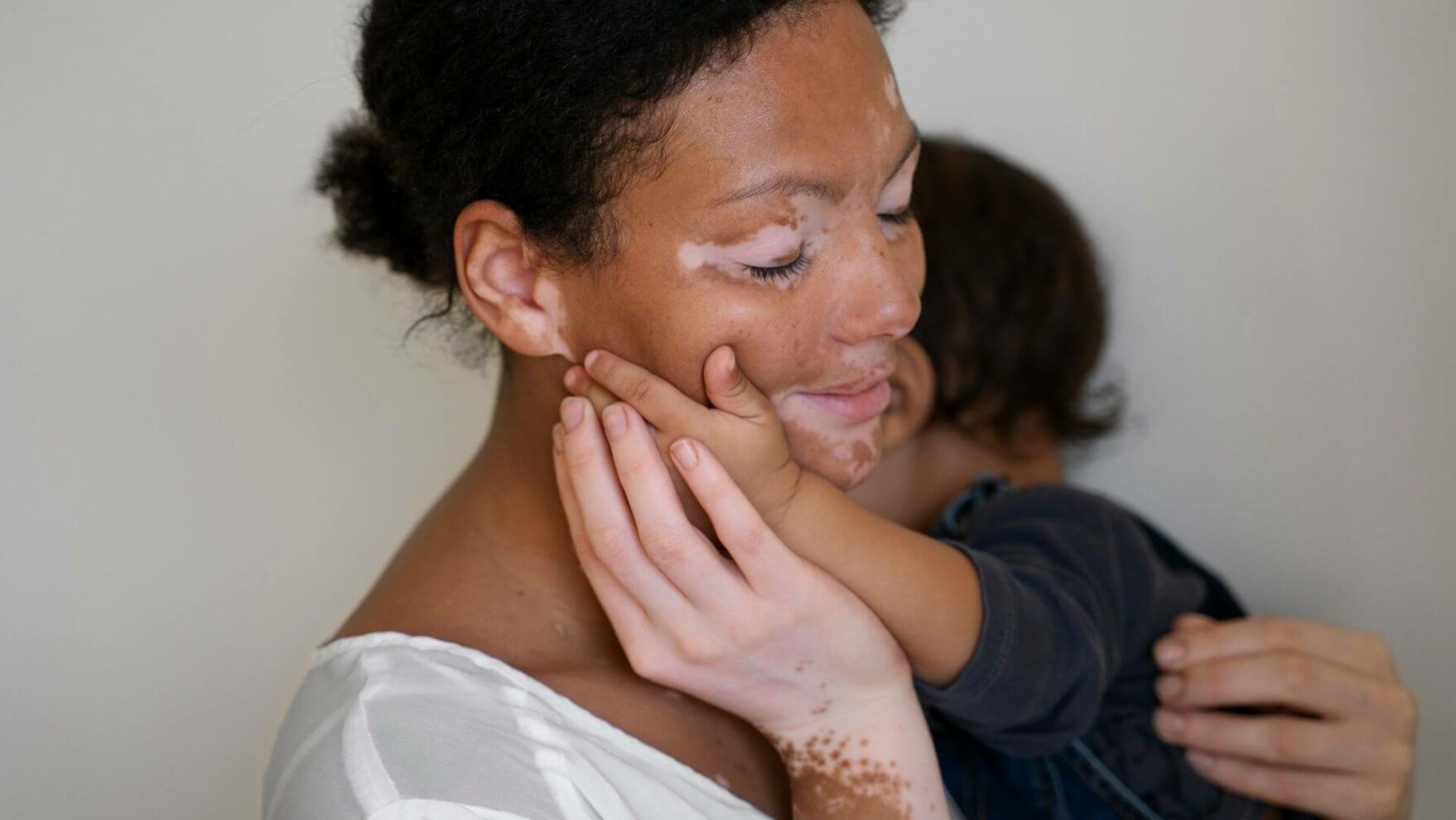 Entenda o que é vitiligo e quais os sintomas