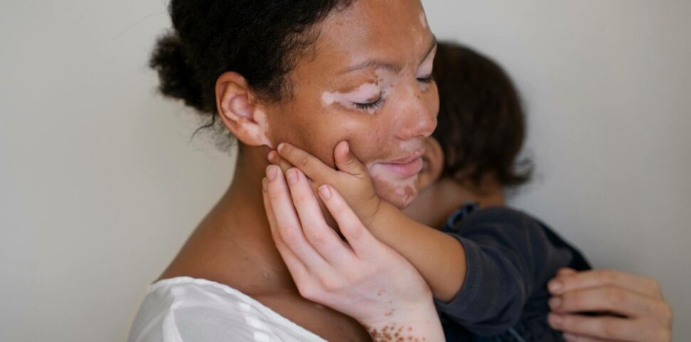 Entenda o que é vitiligo