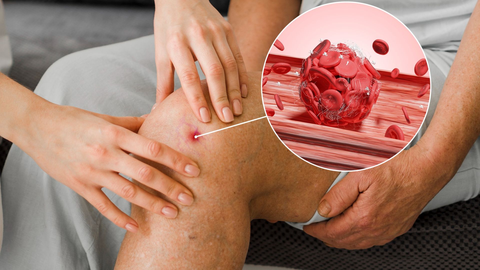 Exames especiais para investigação de trombofilia