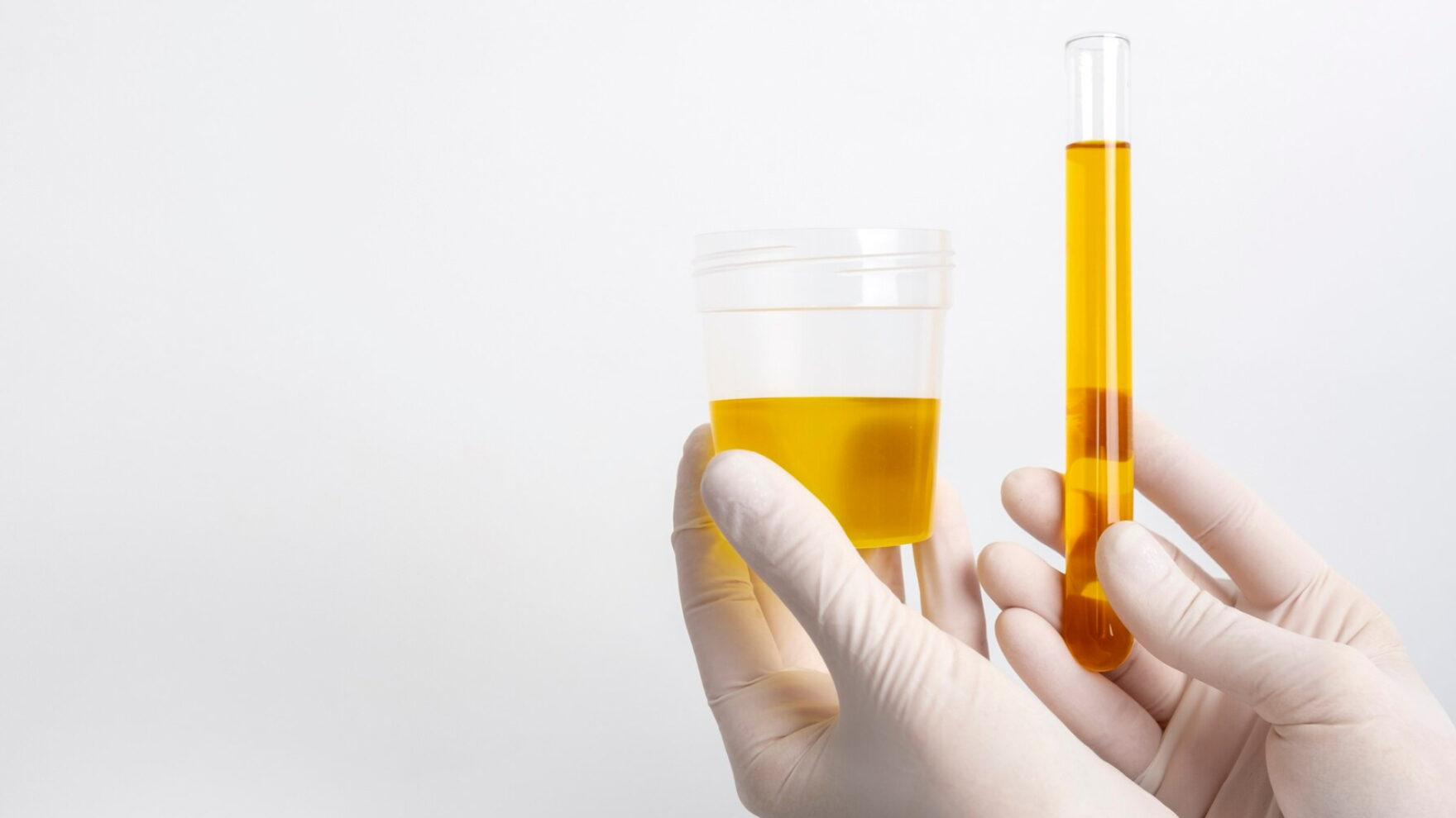 Porfirias: triagem e interpretação bioquímica