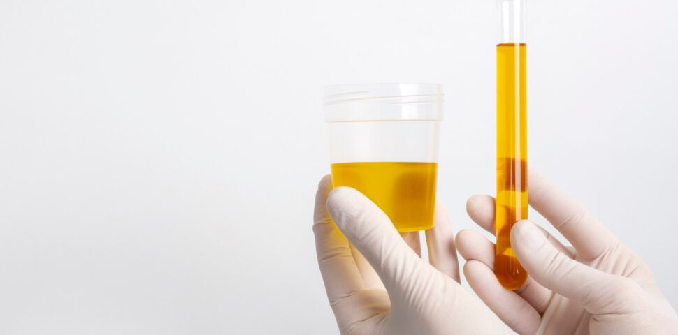 Diagnóstico bioquímico das porfirias