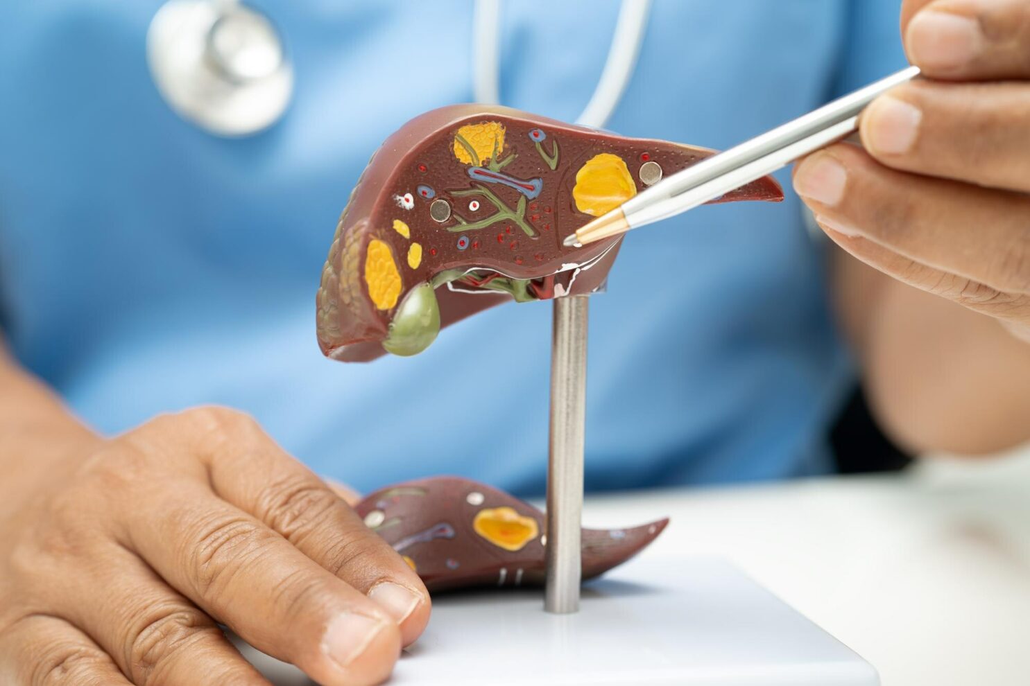 Gordura no fígado: como prevenir a esteatose hepática